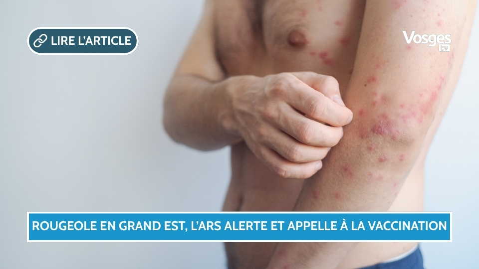 Rougeole en Grand Est, l’ARS alerte et appelle à la vaccination